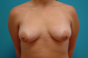 Breast Lift with Augmentation Before and After Pictures Fort Lauderdale, FL