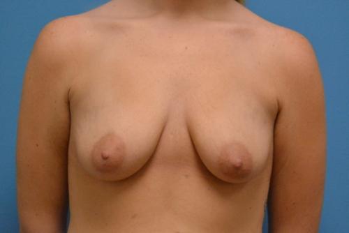 Breast Lift with Augmentation Before and After Pictures Fort Lauderdale, FL