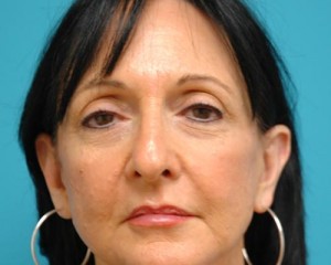 Brow Lift Before and After Pictures Fort Lauderdale, FL
