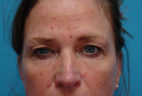 Brow-Lift-09 Brow Lift Before and After Pictures Fort Lauderdale, FL