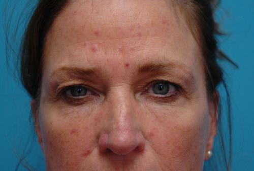 Brow Lift Before and After Pictures Fort Lauderdale, FL