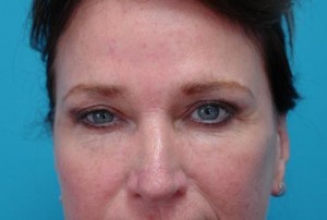 Brow Lift Before and After Pictures Fort Lauderdale, FL