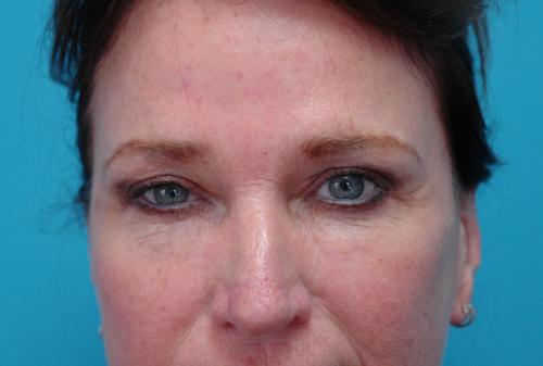 Brow-Lift-10 Brow Lift Before and After Pictures Fort Lauderdale, FL
