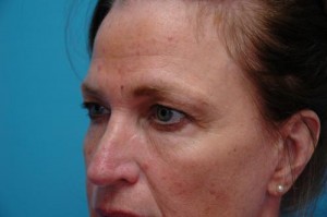 Brow Lift Before and After Pictures Fort Lauderdale, FL