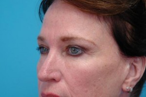 Brow Lift Before and After Pictures Fort Lauderdale, FL