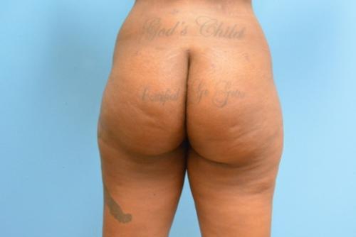 Brazilian Butt Lift Before and After Pictures Fort Lauderdale, FL