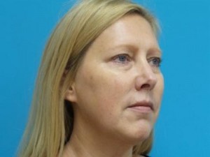 Blepharoplasty Before and After Pictures Fort Lauderdale, FL