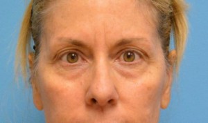 Blepharoplasty Before and After Pictures Fort Lauderdale, FL