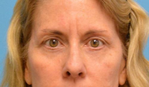 Eyelid-Surgery-06 Blepharoplasty Before and After Pictures Fort Lauderdale, FL