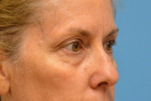 Blepharoplasty Before and After Pictures Fort Lauderdale, FL