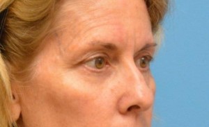 Blepharoplasty Before and After Pictures Fort Lauderdale, FL