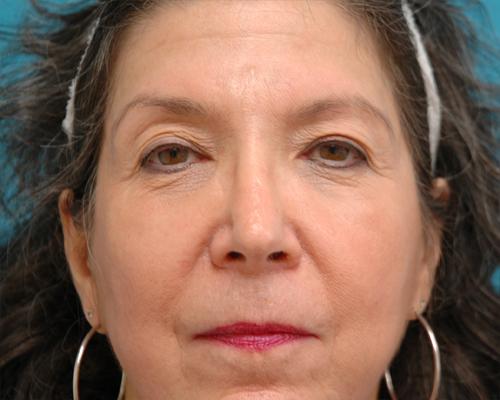 Blepharoplasty Before and After Pictures Fort Lauderdale, FL