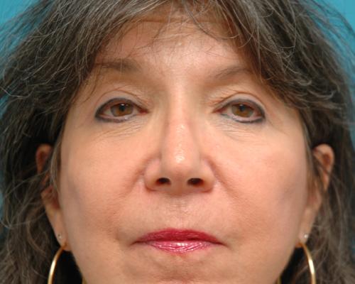 Blepharoplasty Before and After Pictures Fort Lauderdale, FL