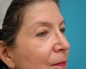 Blepharoplasty Before and After Pictures Fort Lauderdale, FL