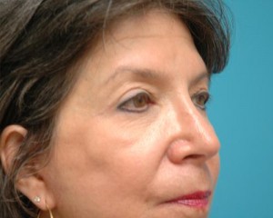 Blepharoplasty Before and After Pictures Fort Lauderdale, FL