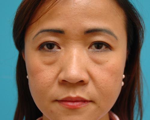 Blepharoplasty Before and After Pictures Fort Lauderdale, FL