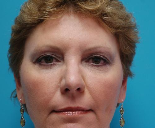 Blepharoplasty Before and After Pictures Fort Lauderdale, FL