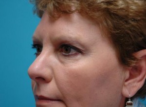 Blepharoplasty Before and After Pictures Fort Lauderdale, FL