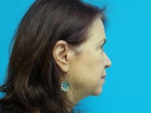 Facelift Before and After Pictures Fort Lauderdale, FL