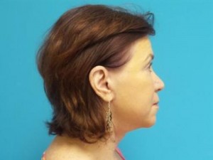 Facelift Before and After Pictures Fort Lauderdale, FL