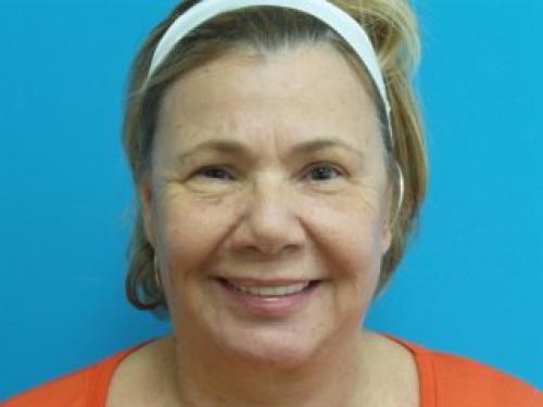 Face-Lift-05 Facelift Before and After Pictures Fort Lauderdale, FL