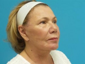 Facelift Before and After Pictures Fort Lauderdale, FL