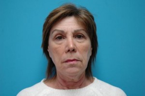 Facelift Before and After Pictures Fort Lauderdale, FL