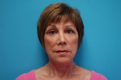 Face-Lift-10 Facelift Before and After Pictures Fort Lauderdale, FL