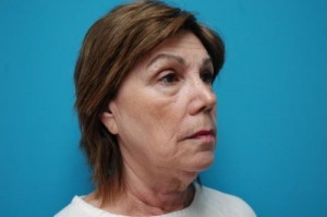Facelift Before and After Pictures Fort Lauderdale, FL