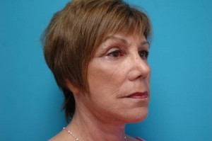 Facelift Before and After Pictures Fort Lauderdale, FL