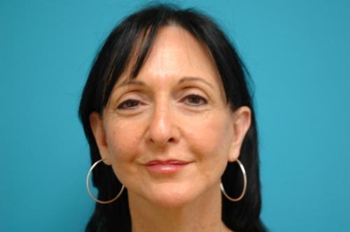 Face-Lift-13 Facelift Before and After Pictures Fort Lauderdale, FL