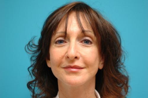 Face-Lift-14 Facelift Before and After Pictures Fort Lauderdale, FL