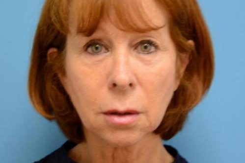 Face-Lift-17 Facelift Before and After Pictures Fort Lauderdale, FL