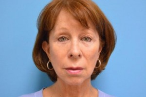 Facelift Before and After Pictures Fort Lauderdale, FL