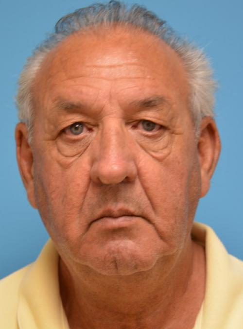 Face-Lift-21 Facelift Before and After Pictures Fort Lauderdale, FL