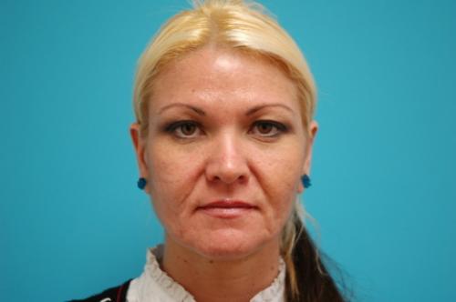 Facelift Before and After Pictures Fort Lauderdale, FL