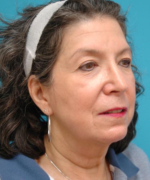Face-Lift-29 Facelift Before and After Pictures Fort Lauderdale, FL