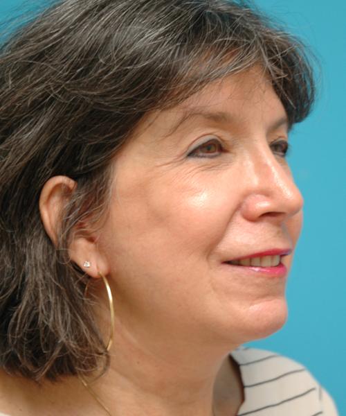 Face-Lift-30 Facelift Before and After Pictures Fort Lauderdale, FL