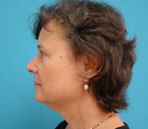 Facelift Before and After Pictures Fort Lauderdale, FL