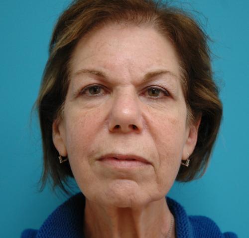 Facelift Before and After Pictures Fort Lauderdale, FL