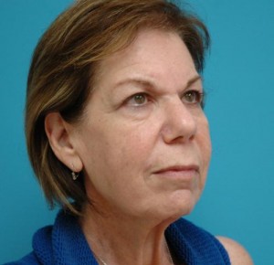 Facelift Before and After Pictures Fort Lauderdale, FL