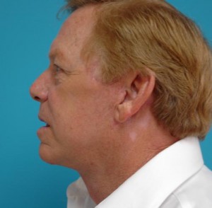 Facelift Before and After Pictures Fort Lauderdale, FL