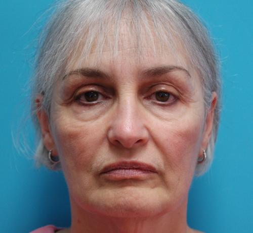 Facelift Before and After Pictures Fort Lauderdale, FL