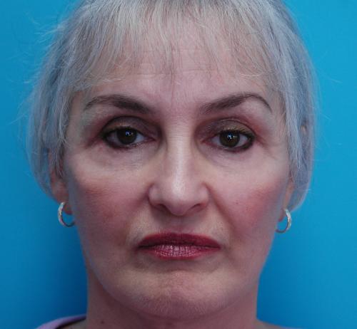 Facelift Before and After Pictures Fort Lauderdale, FL