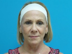 Facelift Before and After Pictures Fort Lauderdale, FL