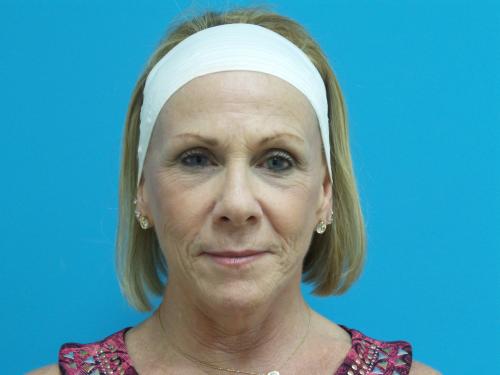 Face-Lift-57 Facelift Before and After Pictures Fort Lauderdale, FL