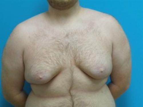 Gynecomastia Before and After Pictures Fort Lauderdale, FL