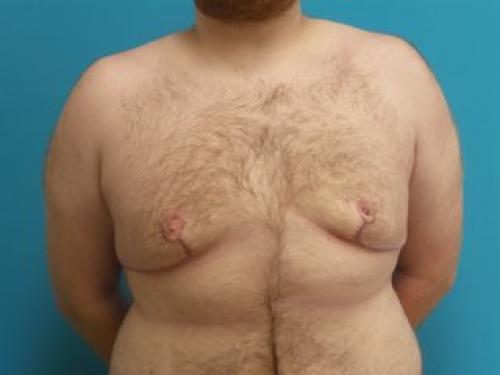 Gynecomastia Before and After Pictures Fort Lauderdale, FL