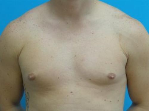 Gynecomastia Before and After Pictures Fort Lauderdale, FL