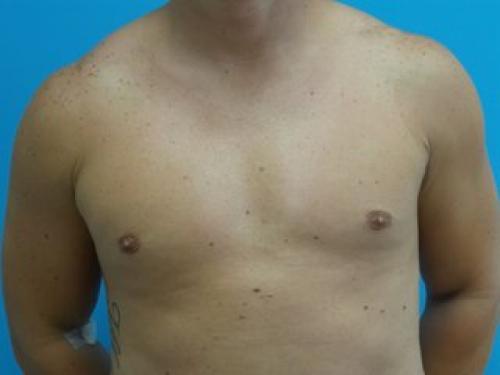 Gynecomastia Before and After Pictures Fort Lauderdale, FL